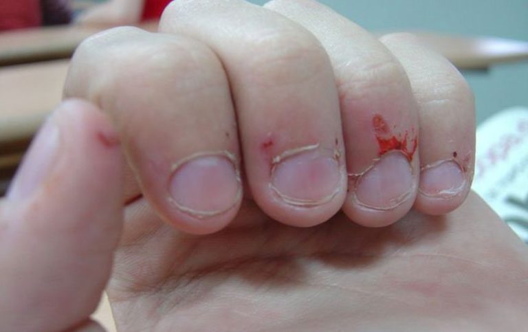 ¿Uñas mordidas? Descubre qué es la onicofagia, cómo acabar con este mal ...